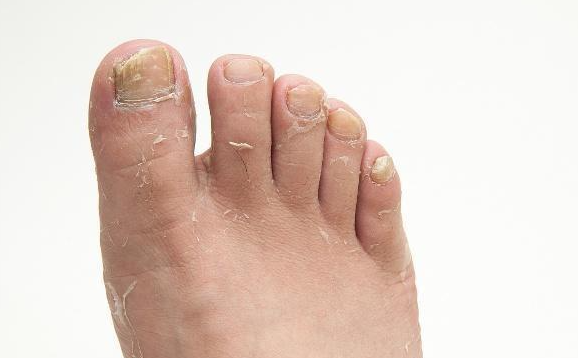 腳氣會(huì )通過(guò)床單傳染嗎 腳氣穿一次鞋能傳染嗎